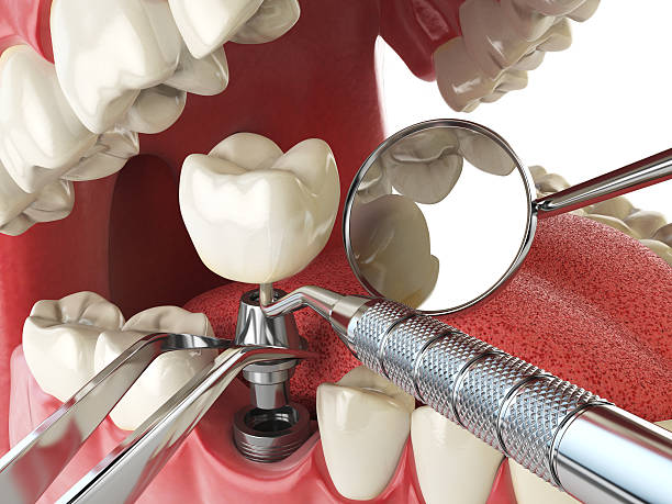 Best Walk-In Emergency Dentist in St James City, FL